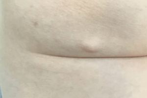 before mole and lesion removal from Epsom Skin Clinic, Surrey