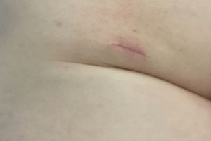 after mole and lesion removal from Epsom Skin Clinic, Surrey